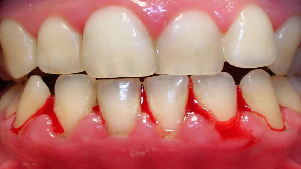 Bleeding gums(Health Jade)