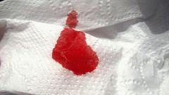 Blood like discharge(Cell Code)