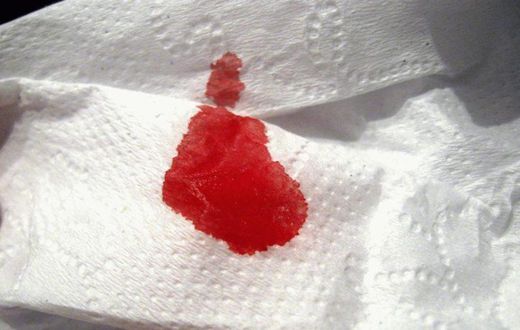 Blood like discharge(Cell Code)