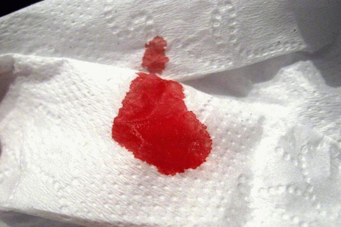 Blood like discharge(Cell Code)