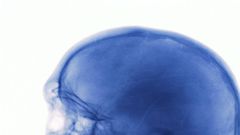 What to Do When You Hit Your Head Really Hard
