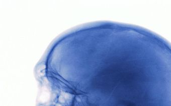 What to Do When You Hit Your Head Really Hard