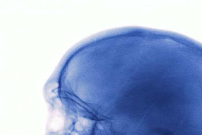 What to Do When You Hit Your Head Really Hard