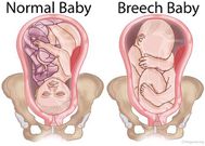 Breech position(PregMed)