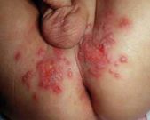 Symptoms of Genital herpes