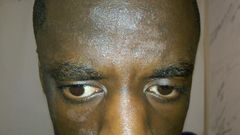 Ringworm on face(The Skin Skoop)