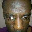 Ringworm on face(The Skin Skoop)