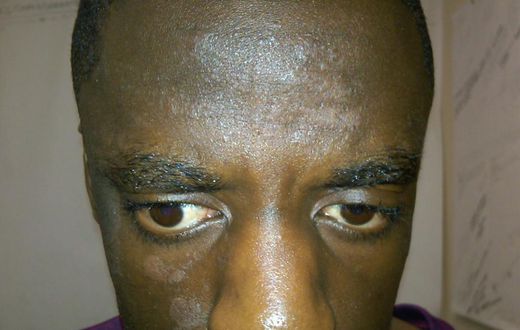 Ringworm on face(The Skin Skoop)