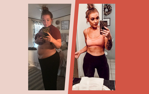 'I Lost 125 Pounds After Gastric Bypass Surgery'