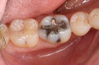 Cracked tooth(Rhondium)