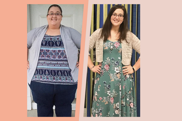 'I Lost 336 Pounds And Had Loose Skin Removed'