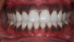 Black gums(Chrysalis Dental Centres)