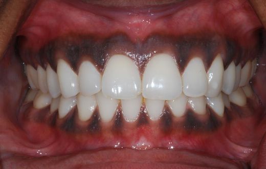 Black gums(Chrysalis Dental Centres)