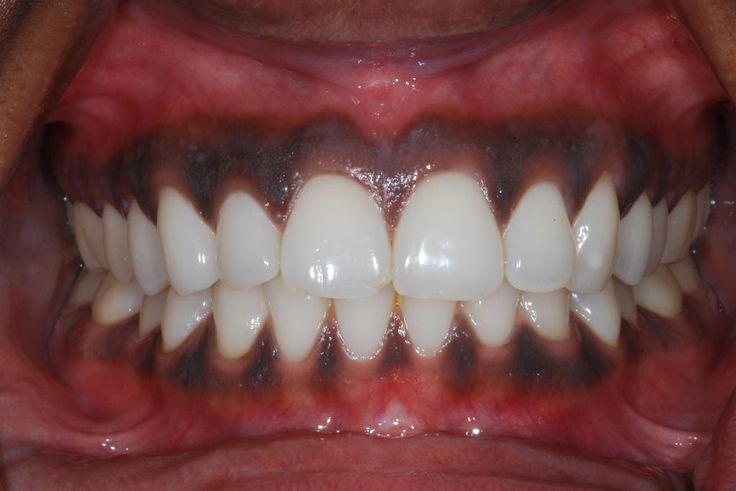 Black gums(Chrysalis Dental Centres)