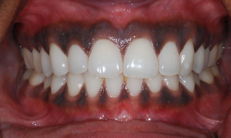 Black gums(Chrysalis Dental Centres)