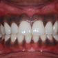 Black gums(Chrysalis Dental Centres)