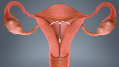 IUD in uterus(Scientific Animations)