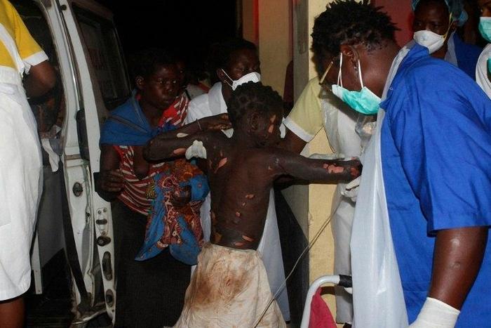 A badly burned child arrives at the Provincial Hospital in Tete, western Mozambique on November 17, 2016, after a truck carrying petrol burst into flames