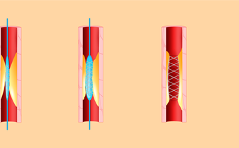 When to Say No to a Heart Stent
