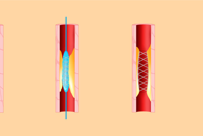 When to Say No to a Heart Stent