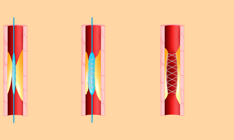 When to Say No to a Heart Stent