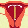 8 Facts About Sex When You Have An IUD