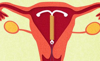 8 Facts About Sex When You Have An IUD