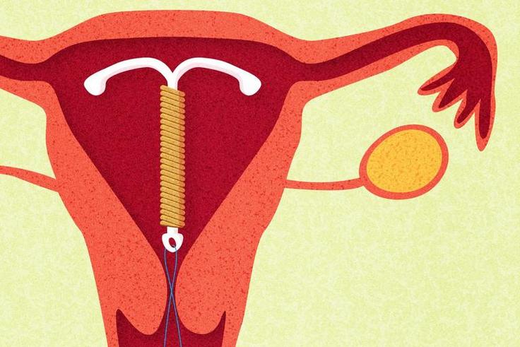 8 Facts About Sex When You Have An IUD
