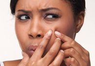 Popping pimples can cause scarring that can last a long time before they heal.