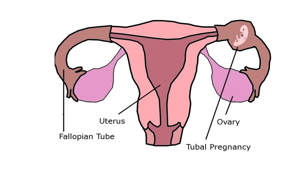 Ectopic pregnancy(Pregnant woman in hospita)