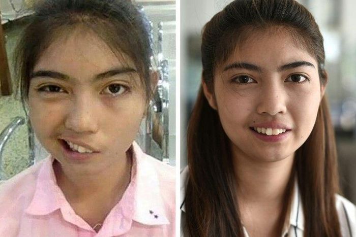 A photo combo by Paveena Foundation in 2016 and AFP's Lillian Suwanrumpha in 2017 of Thai schoolgirl Naruedee Jotsanthia who was left facially disfigured after a schoolteacher who threw a mug at her head
