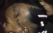 Alopecia areata(sciencedirect)