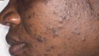 Acne(standardmedia)