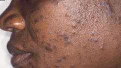 Acne(standardmedia)