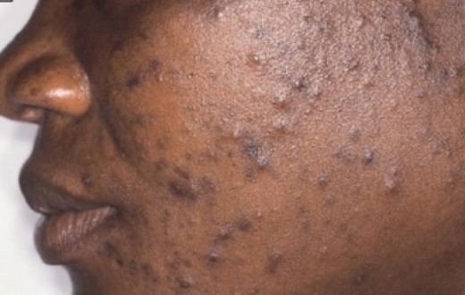 Acne(standardmedia)