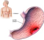 Gastric cancer signs(Health Jade)