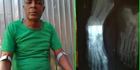 John Mwinga whose foot was run over by a car belonging to Waititu