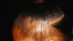 5 natural ways to treat and prevent hair loss