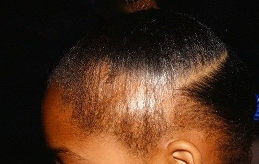 5 natural ways to treat and prevent hair loss