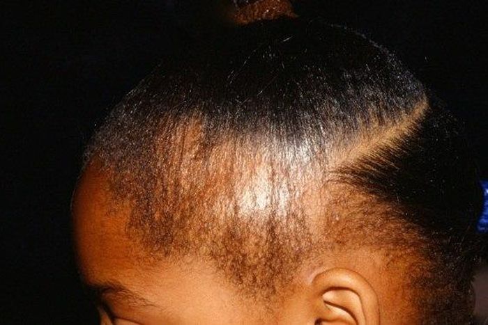 5 natural ways to treat and prevent hair loss