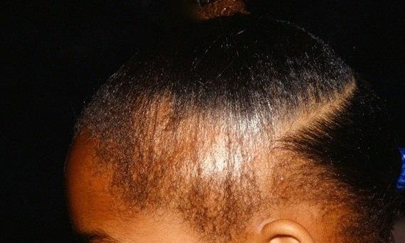 5 natural ways to treat and prevent hair loss
