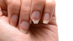 Weak nails (The Woodruff Institute)