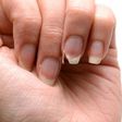 Weak nails (The Woodruff Institute)