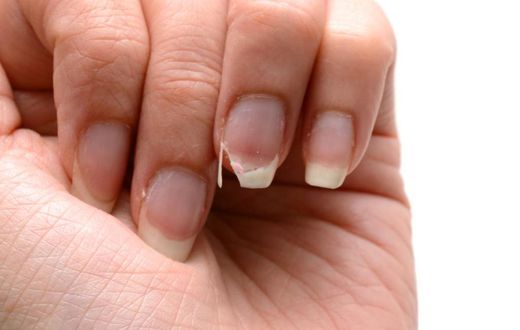 Weak nails (The Woodruff Institute)