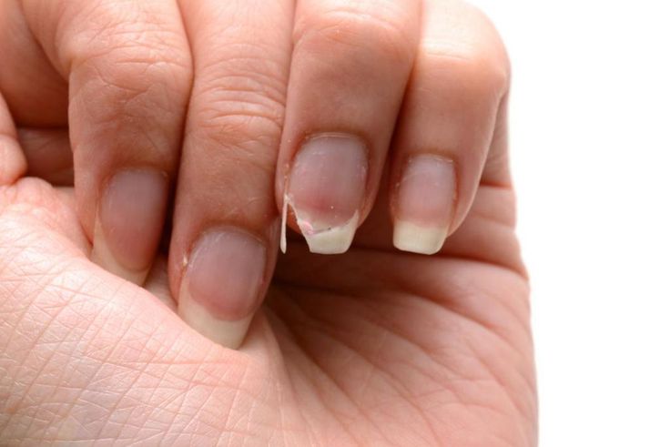 Weak nails (The Woodruff Institute)