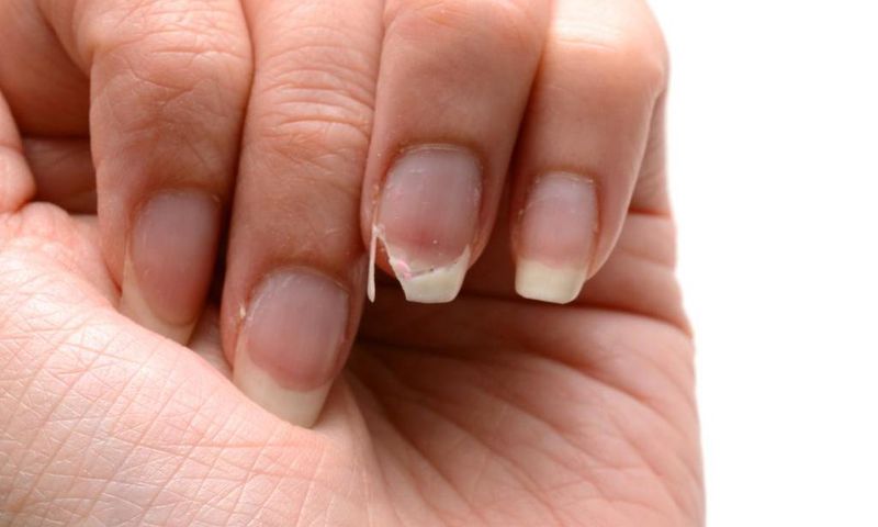 Weak nails (The Woodruff Institute)