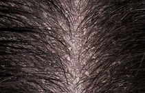 Scalp with dandruff
