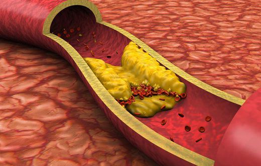 High cholesterol(verywellhealth)