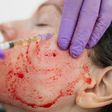 Vampire Facials Might Be Causing HIV