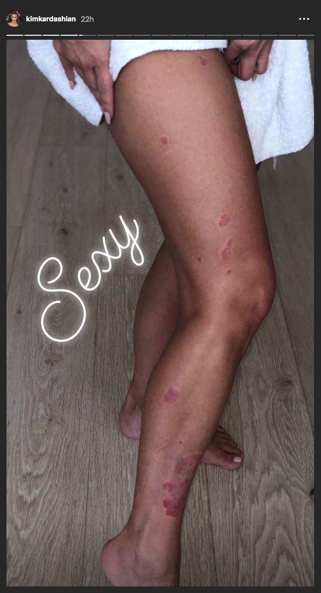 Kim Kardashian Posts New Psoriasis
